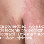 Co może powiedzieć Twoja skóra w trakcie leczenia onkologicznego i chemioterapii?  Bolesna historia pacjentki @onkojelonek