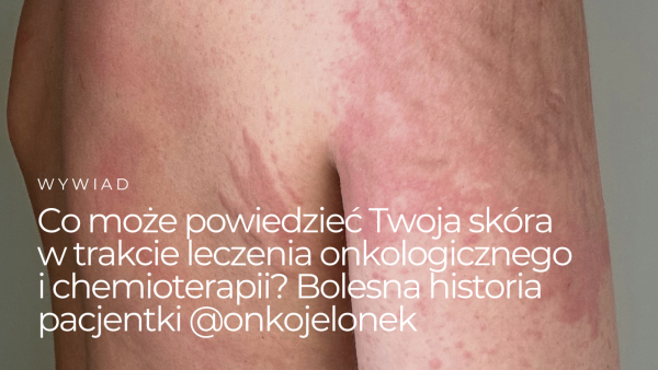 Co może powiedzieć Twoja skóra w trakcie leczenia onkologicznego i chemioterapii?  Bolesna historia pacjentki @onkojelonek