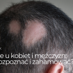 Łysienie u kobiet i mężczyzn – jak je rozpoznać i zahamować?
