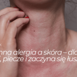 Wiosenna alergia a&nbsp;skóra: dlaczego swędzi, piecze i&nbsp;zaczyna się łuszczyć?