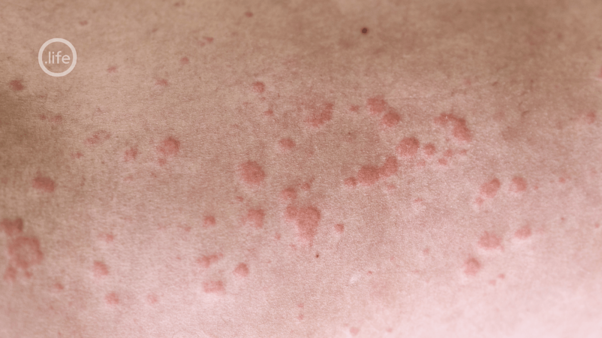 wysypki alergiczne na wiosnę 