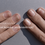 Jak odbudować paznokcie po&nbsp;chemioterapii?